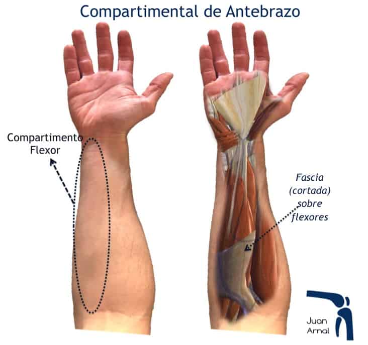 compartimental, sindrome, antebrazo, pierna, correr, moto, enduro, remo, motocross, músculos, dolor muscular, presión, traumatología, cirugía, recuperación, juan arnal, traumatología, deportivo, madrid, mejor, adeslas,