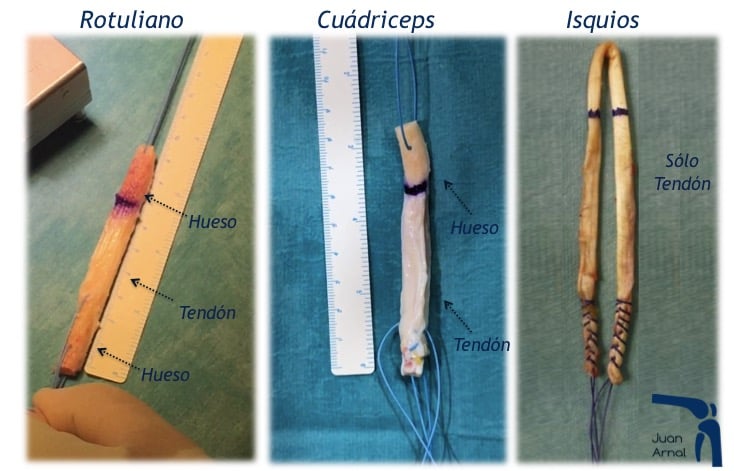 injerto rotuliano, injerto cuadriceps, isquiotibiales, injerto, rotura, cirugia ligamento cruzado anterior, juan arnal, traumatologo, madrid, cirugia, rotura, artroscopia, ligamento cruzado anterior, artroscopia rodilla, sutura menisco, adeslas, asisa, cirujano rodilla, traumatologo deportivo
