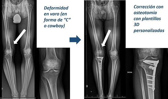 juan arnal, traumatologo, dolor rodilla, piernas desviadas, piernas en c, piernas en circula, rodillas circulares, genu varo, osteotomía tibia, corrección piernas, piernas torcidas, cirugía, adeslas, asisa, cirujano rodilla, traumatologo deportivo