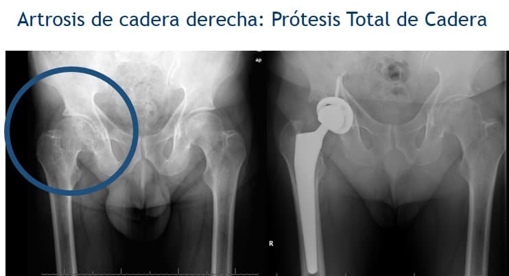 Los materiales pueden ser de titanio o aleación de cromo-cobalto incluso se usa la cerámica en la fabricación de los cotilos y cabezas femorales. Pueden utilizarse prótesis selladas con un cemento de polimetilmetacrilato y las PTC no selladas en las que su unión al hueso se debe a su material poroso que permite el crecimiento del hueso integrando el componente. Además, existen varios modelos de prótesis cuya elección depende, principalmente, del tipo de paciente y la experiencia del cirujano.