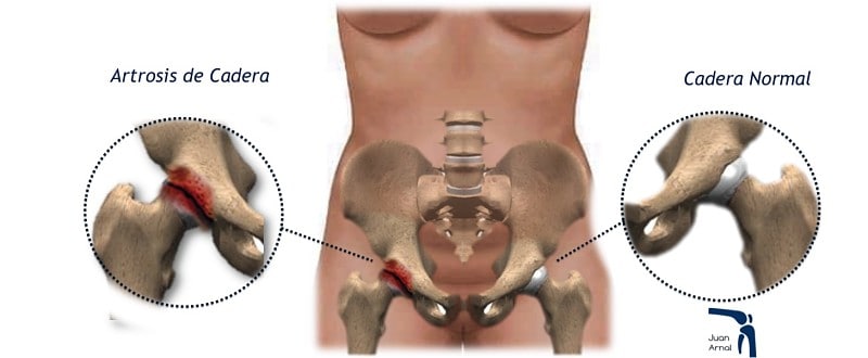 cirujano cadera, artrosis de cadera, coxartrosis, cadera gastada, dolor ingle, no poder cruzar piernas, factores de crecimiento, cirujano Madrid, privado, traumatologo, madrid, dolor rodilla, dolor muslo, dolor femur, protesis cadera, protesis total, salvar cadera, juan arnal, operación cadera, cirugía, muletas