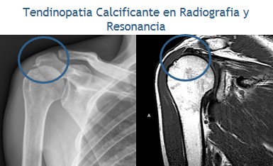 Tendinitis Calcificante del Hombro