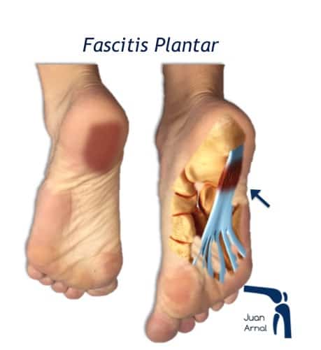 fasciitis plantar, juan arnal, traumatologo madrid, cirugia pie
