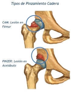 Síndrome de Choque Femoro-Acetabular