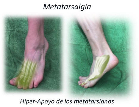 Metatarsalgia