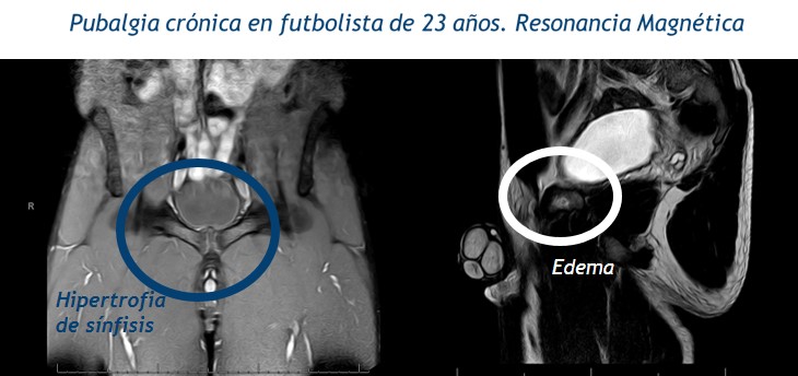 Pubalgia del Deportista