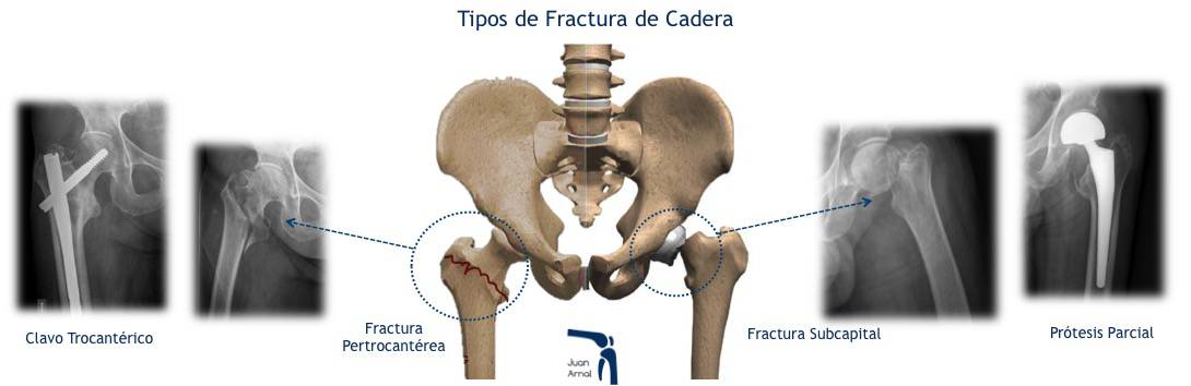 Fracturas de Cadera y Fémur en el Deporte