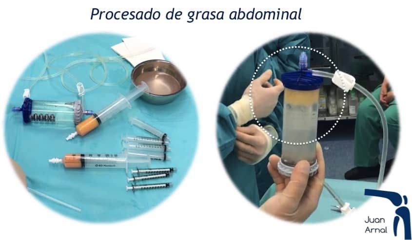 Células madre, mesenquimales, artrosis, regeneración, cartílago, artrosis, rodilla, cadera, prp, factores crecimiento, plasma, plaquetas, células madre, tendón, Aquiles, rotuliano, supraespinoso, tendinitis, epicondilitis, codo tenista, curación, dolor, , terapia biológica, traumatología deportiva, infiltración, ecografía, juan arnal, madrid, deporte, recuperación, rotura muscular, vuelta al deporte, correr, lesion,