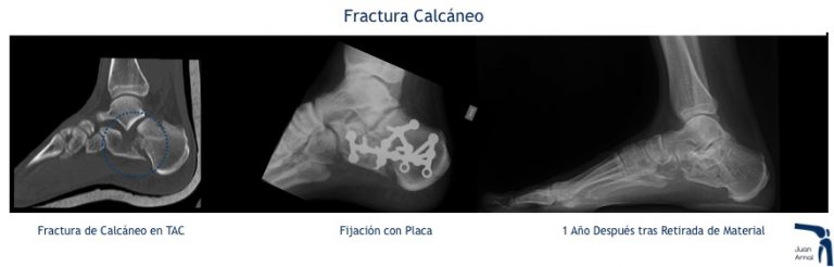 juan arnal, traumatologo, madrid, rotura, fractura, cirugia, deporte, recuperacion, operacion,