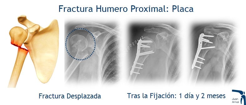 juan arnal, traumatologo, madrid, rotura, fractura, cirugia, deporte, recuperacion, operacion, fractura hombro, humero