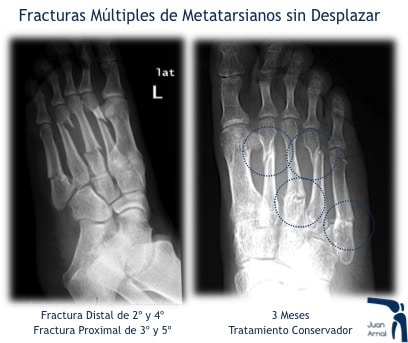 juan arnal, traumatologo, madrid, rotura, fractura, cirugia, deporte, recuperacion, operacion,