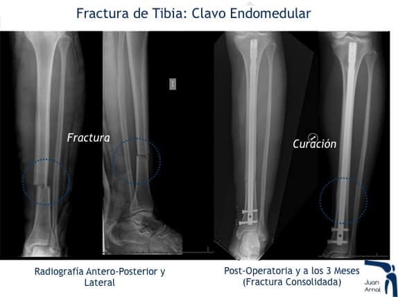 juan arnal, traumatologo, madrid, rotura, fractura, cirugia, deporte, recuperacion, operacion,