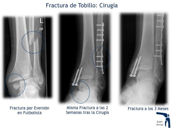 juan arnal, traumatologo, madrid, rotura, fractura, cirugia, deporte, recuperacion, operacion,
