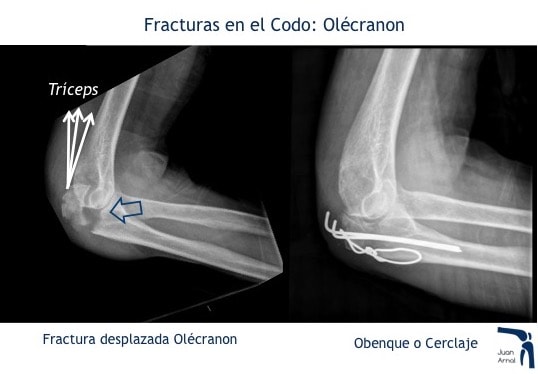 juan arnal, traumatologo, madrid, rotura, fractura, cirugia, deporte, recuperacion, operacion,