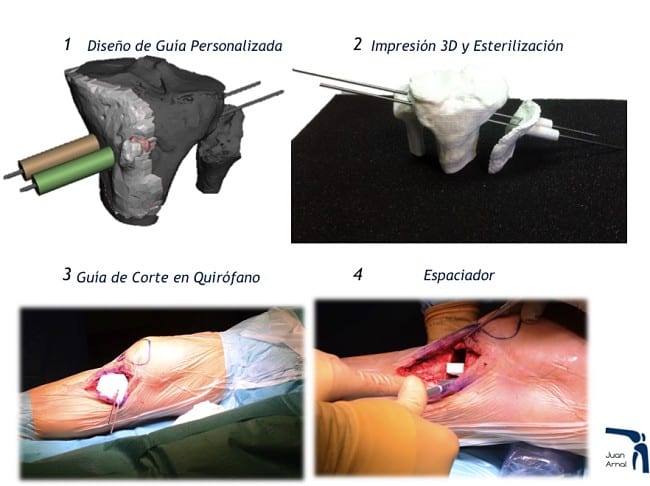 genu varo, genu valgo, piernas torcidas, cirugia, artrosis, rodilla, piernas circulo, tres dimensiones, corrección, osteotomia rodilla, corte hueso, traumatologo, dolor rodilla, piernas desviadas, piernas en c, piernas en circula, rodillas circulares, genu varo, osteotomía tibia, corrección piernas, piernas torcidas, cirugía, adeslas, asisa, cirujano rodilla, traumatologo deportivo