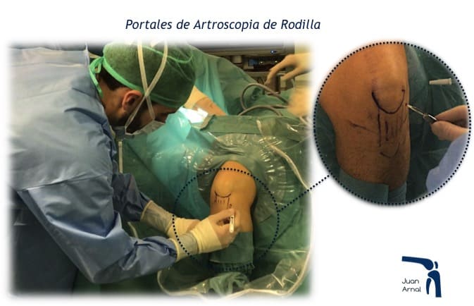 juan arnal, traumatologo, dolor rodilla, rotura asa de cubo, rotura cuerno posterior, roto menisco, rotura menisco, ligamento cruzado anterior, artroscopia rodilla, sutura menisco, adeslas, asisa, cirujano rodilla, traumatologo deportivo