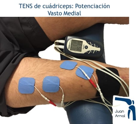 electro estimulacion, terapia, ejercicios rodilla, recuperación, cirugia, juan arnal, traumatologo, madrid, adeslas, privado,