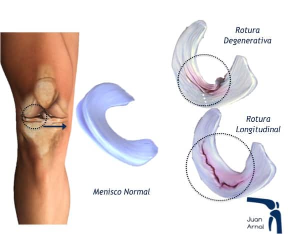 juan arnal, traumatologo, dolor rodilla, rotura asa de cubo, rotura cuerno posterior, roto menisco, rotura menisco, ligamento cruzado anterior, artroscopia rodilla, sutura menisco, adeslas, asisa, cirujano rodilla, traumatologo deportivo