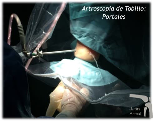 tobillo, cirujano, artroscopia tobillo, osteondritis astrágalo, choque tobillo, impingement, juan arnal, traumatologo, bulto tobilloa, cirugía, adeslas, asisa, cirujano rodilla, traumatologo deportivo, esguince, corredor, inflamacion