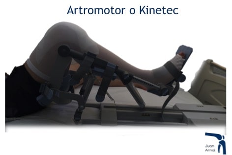 artromotor, kinetec, prótesis rodilla, recuperación, modelos, cirugía artrosis rodilla, prótesis parcial rodilla, nuevo modelo prótesis rodilla, prótesis mínima rodilla, mínima cicatriza, unicompartimental, sustitución rodilla, cambiar rodilla, protesis rodilla, cirujano rodilla, artrosis, dolor rodilla, mejor cirujano rodilla, madrid, artrosis, condromalacia, traumatologo,