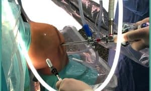 artroscopia de rodilla, ligamento cruzado anterior, rotura de menisco, traumatología deportiva, deporte, futbol, correr, atletismo, cirugía rodilla, rodilla, adeslas, santas, asisa, madrid, juan arnal,