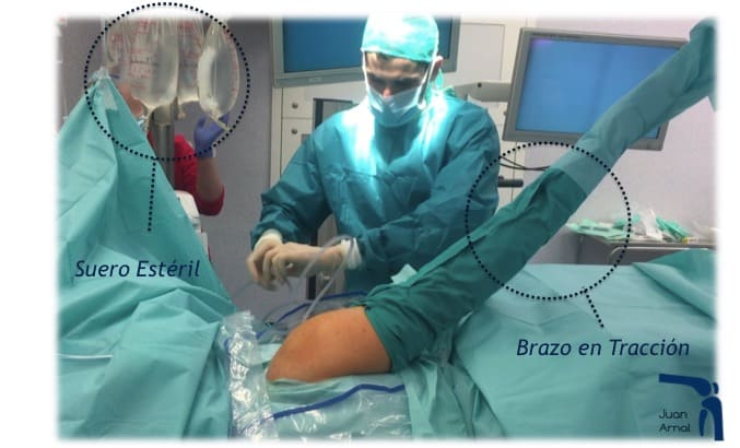 artroscopia hombro, manguito rotador, tendinitis calcificante, tendinitis, supraespinoso, bursitis hombro, acromion, sindrome, rotadores, tendon hombro, tendinitis, tratamiento , cirugía, adeslas, privado, madrid, juan arnal, traumatologo,