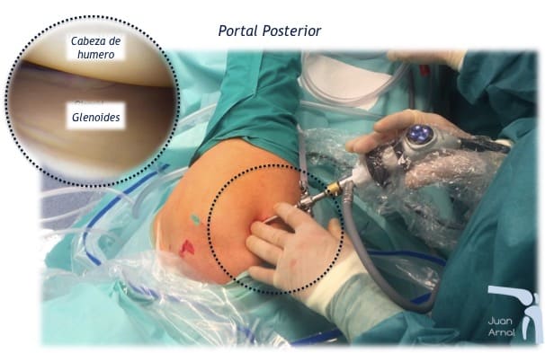 artroscopia hombro, manguito rotador, tendinitis calcificante, tendinitis, supraespinoso, bursitis hombro, acromion, sindrome, rotadores, tendon hombro, tendinitis, tratamiento , cirugía, adeslas, privado, madrid, juan arnal, traumatologo,