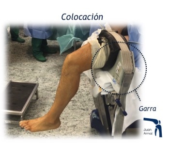 juan arnal, traumatologo, dolor rodilla, rotura asa de cubo, rotura cuerno posterior, roto menisco, rotura menisco, ligamento cruzado anterior, artroscopia rodilla, sutura menisco, adeslas, asisa, cirujano rodilla, traumatologo deportivo