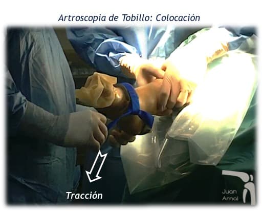 tobillo, cirujano, artroscopia tobillo, osteondritis astrágalo, choque tobillo, impingement, juan arnal, traumatologo, bulto tobilloa, cirugía, adeslas, asisa, cirujano rodilla, traumatologo deportivo, esguince, corredor, inflamacion
