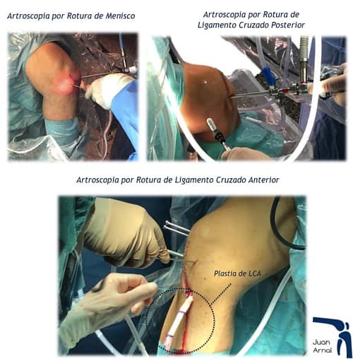 juan arnal, traumatologo, dolor rodilla, rotura asa de cubo, rotura cuerno posterior, roto menisco, rotura menisco, ligamento cruzado anterior, artroscopia rodilla, sutura menisco, adeslas, asisa, cirujano rodilla, traumatologo deportivo