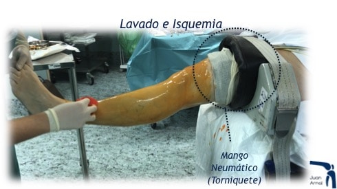 juan arnal, traumatologo, dolor rodilla, rotura asa de cubo, rotura cuerno posterior, roto menisco, rotura menisco, ligamento cruzado anterior, artroscopia rodilla, sutura menisco, adeslas, asisa, cirujano rodilla, traumatologo deportivo