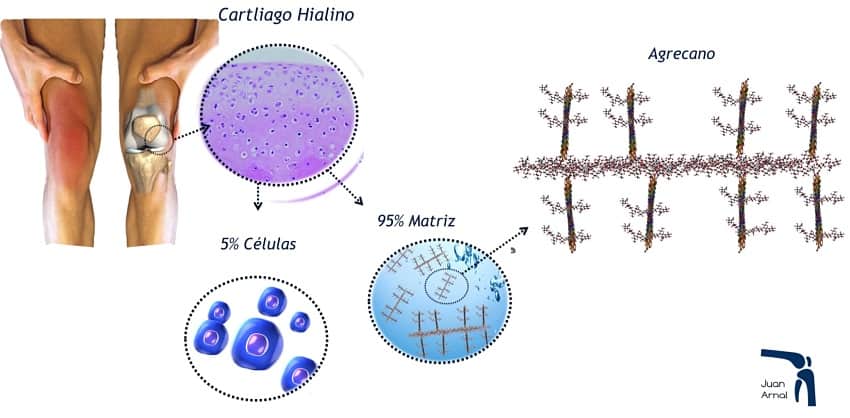 Acido hialuronico, rodilla, cadera, infiltración, hialurónico, lubricar, dolor rodilla, condromalacia, osteocondritis, infiltración rodilla, pinchazo rodilla, prp, células madre, lesión cartílago, ulcera, cartílago, juan arnal, traumatologo, meniscos, rotura menisco, artroscopia rodilla, tobillo, artrosis rodilla, adeslas, asisa, cirujano rodilla, traumatologo deportivo