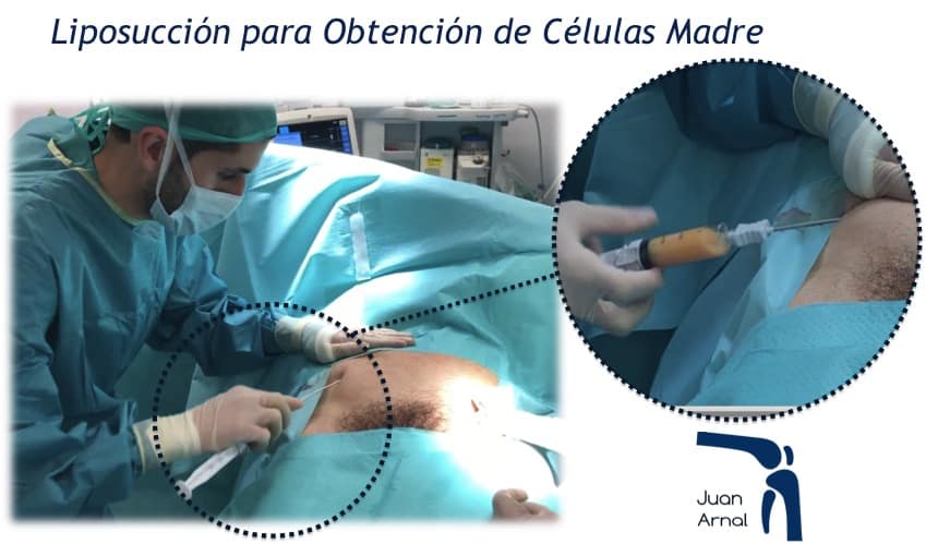 Células madre, mesenquimales, artrosis, regeneración, cartílago, artrosis, rodilla, cadera, prp, factores crecimiento, plasma, plaquetas, células madre, tendón, Aquiles, rotuliano, supraespinoso, tendinitis, epicondilitis, codo tenista, curación, dolor, , terapia biológica, traumatología deportiva, infiltración, ecografía, juan arnal, madrid, deporte, recuperación, rotura muscular, vuelta al deporte, correr, lesion,