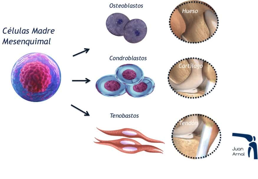 Células madre, juan arnal, mesenquimales, artrosis, regeneración, cartílago, artrosis, rodilla, cadera, prp, factores crecimiento, plasma, plaquetas, células madre, tendón, Aquiles, rotuliano, supraespinoso, tendinitis, epicondilitis, codo tenista, curación, dolor, , terapia biológica, traumatología deportiva, infiltración, ecografía, juan arnal, madrid, deporte, recuperación, rotura muscular, vuelta al deporte, correr, lesion,