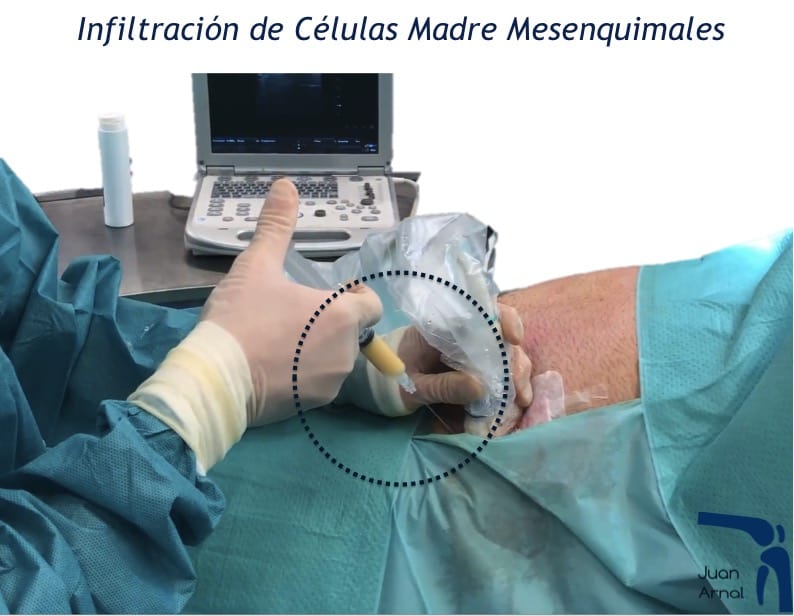 Células madre, mesenquimales, artrosis, regeneración, cartílago, artrosis, rodilla, cadera, prp, factores crecimiento, plasma, plaquetas, células madre, tendón, Aquiles, rotuliano, supraespinoso, tendinitis, epicondilitis, codo tenista, curación, dolor, , terapia biológica, traumatología deportiva, infiltración, ecografía, juan arnal, madrid, deporte, recuperación, rotura muscular, vuelta al deporte, correr, lesion,