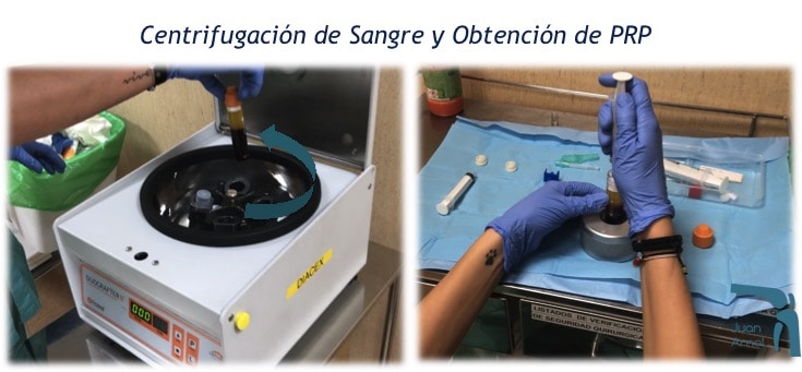 prp, factores crecimiento, plasma, plaquetas, células madre, tendón, Aquiles, rotuliano, supraespinoso, tendinitis, epicondilitis, codo tenista, curación, dolor, células sangre, terapia biológica, traumatología deportiva, infiltración, ecografía, juan arnal, madrid, deporte, recuperación, rotura muscular, vuelta al deporte, correr, lesion,