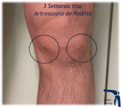 cicatrices, portales, dolor rodilla, rotura asa de cubo, rotura cuerno posterior, roto menisco, rotura menisco, ligamento cruzado anterior, artroscopia rodilla, sutura menisco, adeslas, asisa, cirujano rodilla, traumatologo deportivo