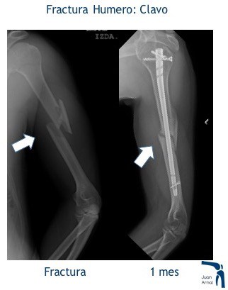 juan arnal, traumatologo, madrid, rotura, fractura, cirugia, deporte, recuperacion, operacion,