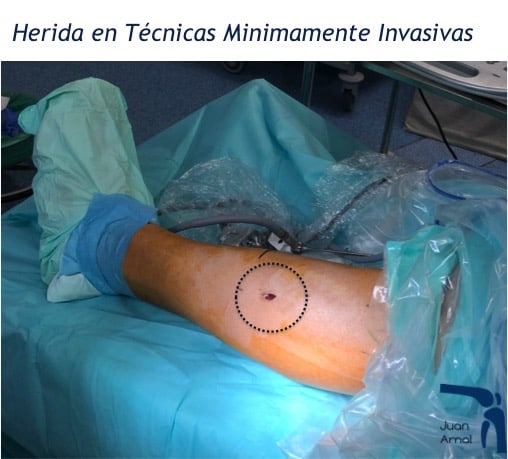 sindrome, corredor, compartimento, muscular, dolor, pierna, correr, ecografía, mis, ultra, mínimamente, invasiva, intervención, sin incisiones, juan arnal, traumatologo, madrid, cirugia ecoguiada, mis, exploración, medición, presión, fútbol, running, dolor, fisioterapia, tibial anterior, periostitis,