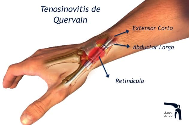 tendinitis mano, traumatologo, madrid, juan arnal, dolor muñeca