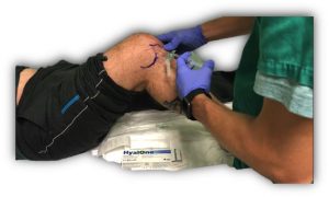 Acido hialuronico, rodilla, cadera, infiltración, hialurónico, lubricar, dolor rodilla, condromalacia, osteocondritis, infiltración rodilla, pinchazo rodilla, prp, células madre, lesión cartílago, ulcera, cartílago, juan arnal, traumatologo, meniscos, rotura menisco, artroscopia rodilla, tobillo, artrosis rodilla, adeslas, asisa, cirujano rodilla, traumatologo deportivo