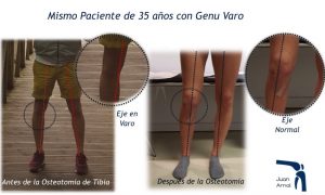 juan arnal, traumatologo, dolor rodilla, piernas desviadas, piernas en c, piernas en circula, rodillas circulares, genu varo, osteotomía tibia, corrección piernas, piernas torcidas, cirugía, adeslas, asisa, cirujano rodilla, traumatologo deportivo