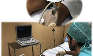 prp, factores crecimiento, plasma, plaquetas, células madre, tendón, Aquiles, rotuliano, supraespinoso, tendinitis, epicondilitis, codo tenista, curación, dolor, células sangre, terapia biológica, traumatología deportiva, infiltración, ecografía, juan arnal, madrid, deporte, recuperación, rotura muscular, vuelta al deporte, correr, lesion,