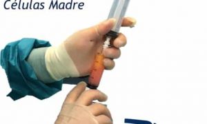 Células madre, mesenquimales, artrosis, regeneración, cartílago, artrosis, rodilla, cadera, prp, factores crecimiento, plasma, plaquetas, células madre, tendón, Aquiles, rotuliano, supraespinoso, tendinitis, epicondilitis, codo tenista, curación, dolor, , terapia biológica, traumatología deportiva, infiltración, ecografía, juan arnal, madrid, deporte, recuperación, rotura muscular, vuelta al deporte, correr, lesion,