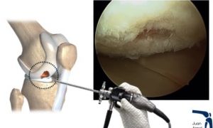 osteocondritis, artroscopia, tratamiento, células madre, rodilla, correr, dolor, lesion cartilago rodilla ulcera osteocondritis