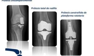 juan arnal, protesis rodilla, cirujano rodilla, artrosis, dolor rodilla, mejor cirujano rodilla, madrid, artrosis, condromalacia, traumatologo,