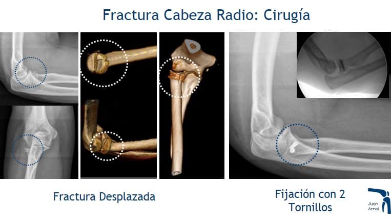 juan arnal, traumatologo, fractura codo, cirugia, tratamiento, traumatologo, madrid