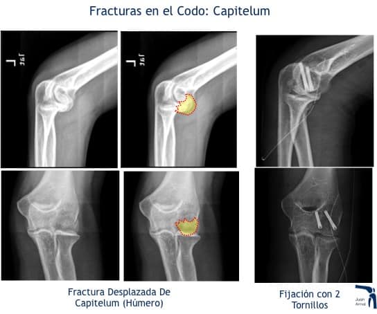 juan arnal, traumatologo, madrid, rotura, fractura, cirugia, deporte, recuperacion, operacion,