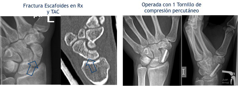 juan arnal, traumatologo, madrid, rotura, fractura, cirugia, deporte, recuperacion, operacion,