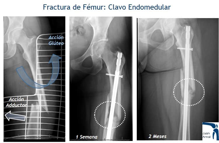 juan arnal, traumatologo, madrid, cirugia, fractura, cadera, dolor cadera, caida, artrosis